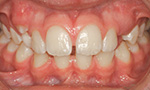 Diastema mediale