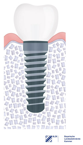 normal eingeheiltes Implantat