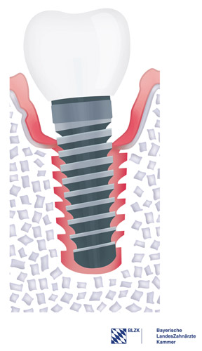 Periimplantitis