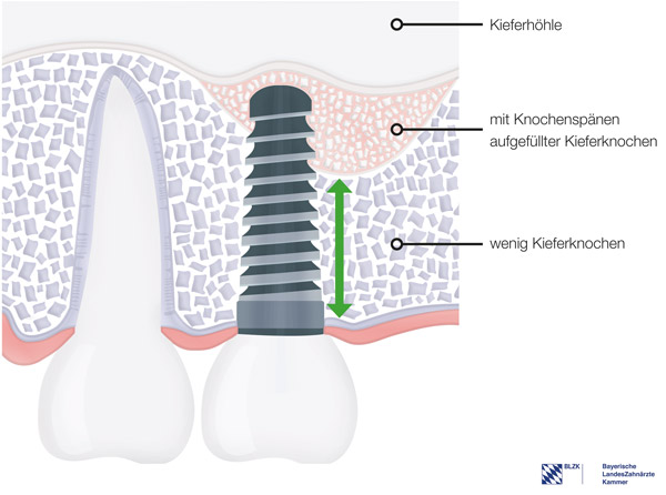 Mit Knochenspnen aufgefllter Kieferknochen